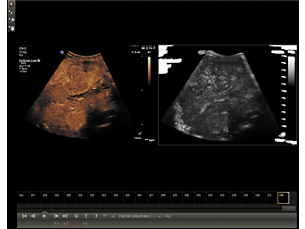 - US Q-App Microvascular Imaging (MVI)