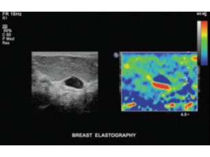 US Q-App Elastography Analysis (EA)****