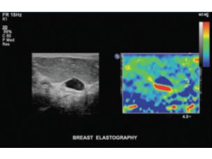 US Q-App Elastography Quantification (EQ)***