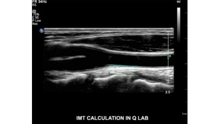 Intima Media Thickness (IMT)