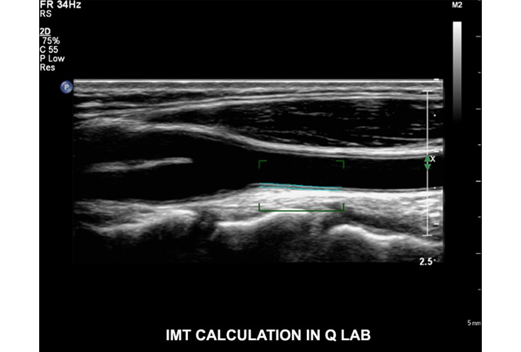 Intima Media Thickness (IMT) || Diagnostic confidence