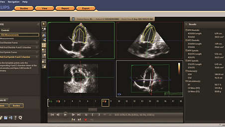 Cardiac 3D Quantification (3DQ)