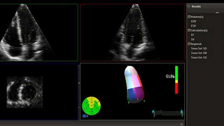 Erweiterte 3D-Quantifizierung des Herzens (3DQA)