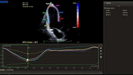 Automated Cardiac Motion Quantificationᴬᴵ (aCMQᴬᴵ)