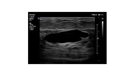 Tissue Harmonic Imaging (THI)