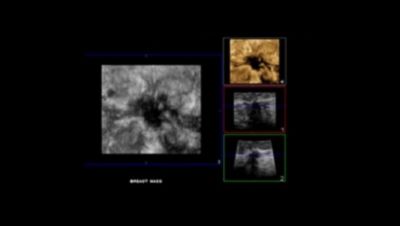 Philips - EPIQ 7 Ultrasound System For Breast Imaging