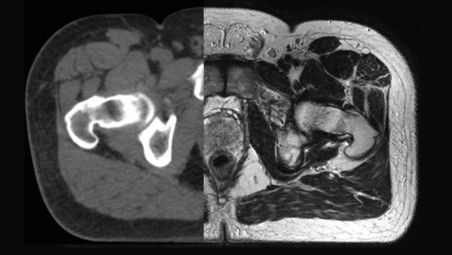 Drive the precision of radiation therapy