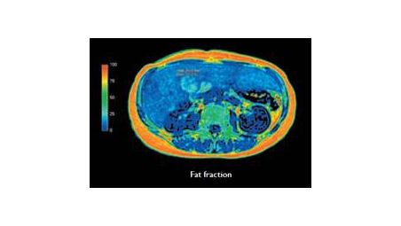 Non-invasive fatty liver assessment