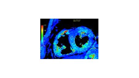 Non-invasive assessment of myocardial tissue