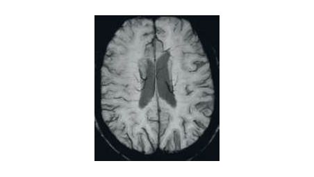 Susceptibility weighted imaging