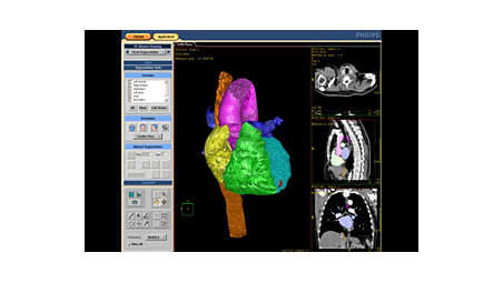 Планирование и навигация при имплантации клапанов сердца (TAVI)