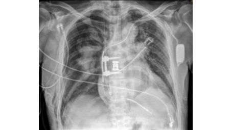 Schnelle Thorax-Bildgebung