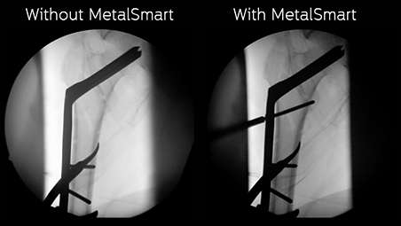MetalSmart - Excluye artefactos causados por implantes metálicos de forma automática