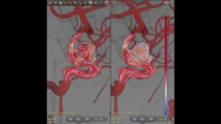 AneurysmFlow: Enhances insight into cerebral aneurysm
