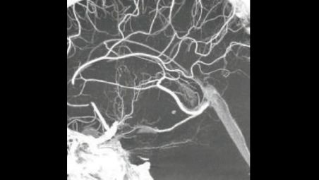 Enhanced VasoCT:
Unmatched spatial resolution