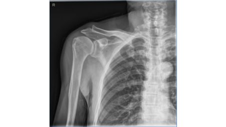 Quality digital X-ray images