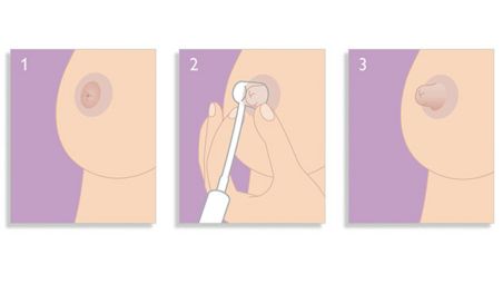 Order Supple Cups: a treatment for inverted nipples and flat nipples- works  better than the Avent Niplette