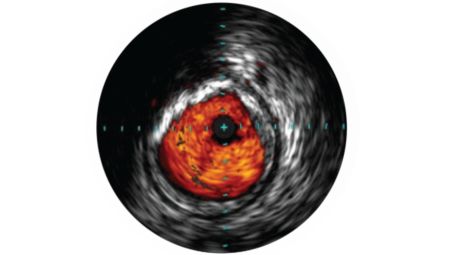 IVUS ayuda a evaluar la enfermedad