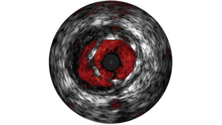 Evaluación de la aposición de stent ChromaFlo