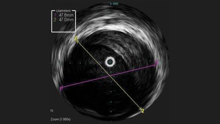 IVUS ayuda a evaluar la enfermedad