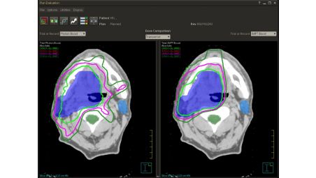 Intensity Modulated Proton Therapy (IMPT)