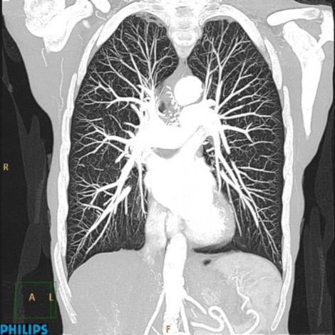 spectral CT image