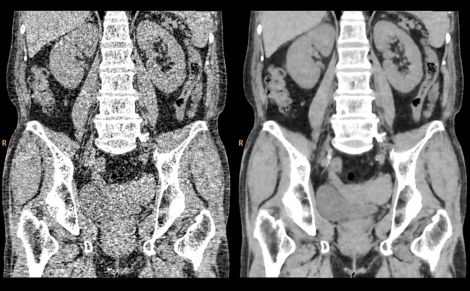 spectral CT image