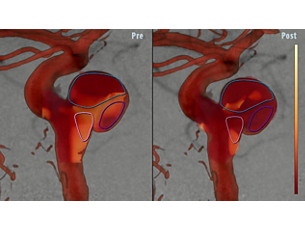 AneurysmFlow Cerebral aneurysm flow quantification