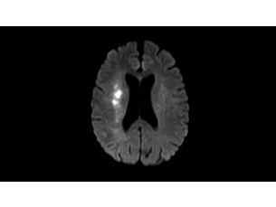 Diffusion Klinische MR-Anwendung