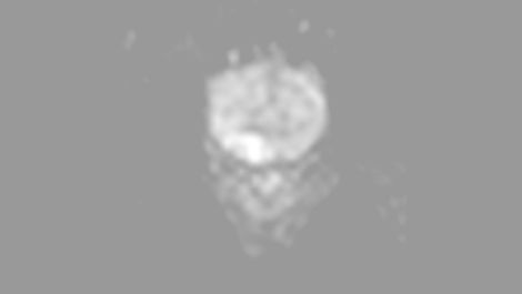 Diffusion Klinische MR-Anwendung