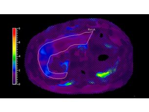 MR Elastography Klinische MR-Anwendung