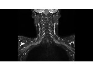 3D NerveVIEW Klinische MR-Anwendung