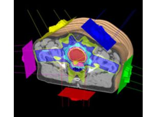 Pinnacle&sup3; Pianificazione e calcolo della dose