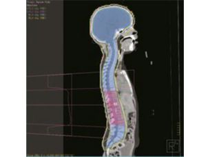 Pinnacle&sup3; Integrated proton-photon treatment planning