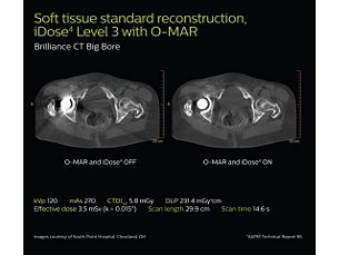 O-MAR Metal artifact reduction for orthopedic implants