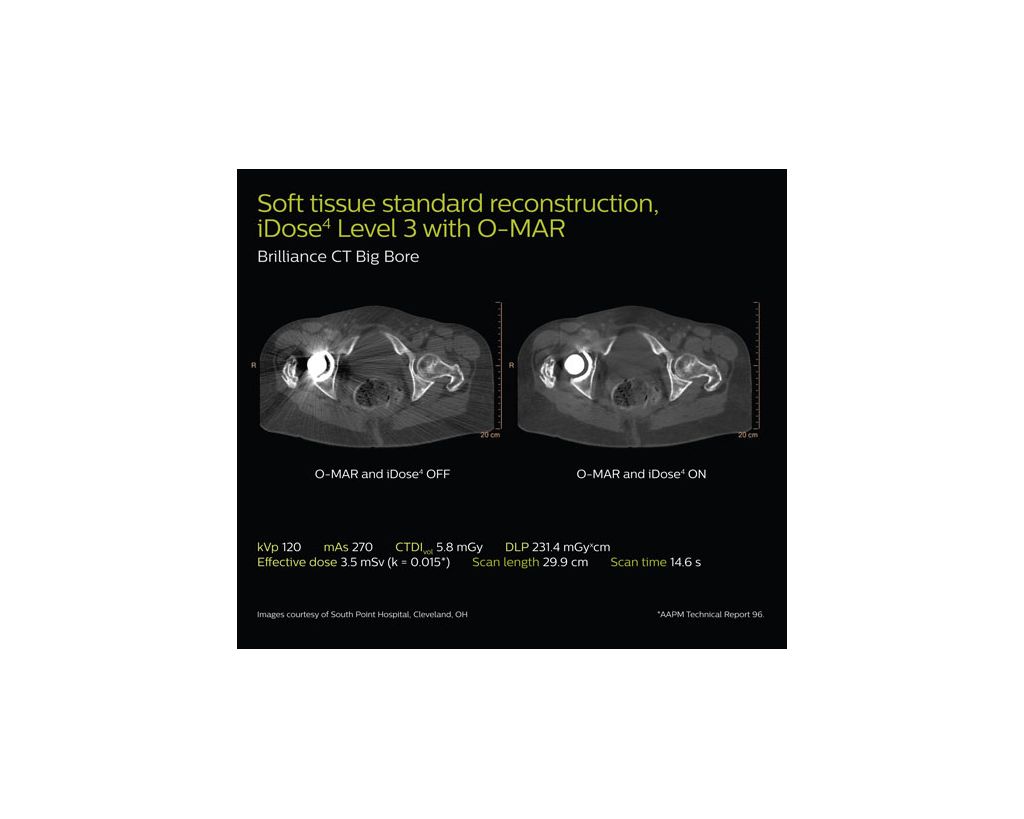 O-MAR Metal artifact reduction for orthopedic implants