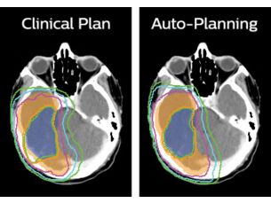 Pinnacle³ Accelerated IMRT &amp; VMAT planning