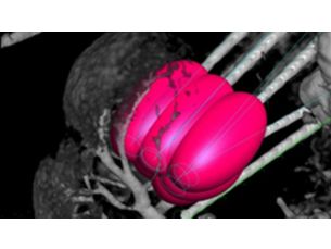 XperGuide 消融 治疗规划和电极针引导工具