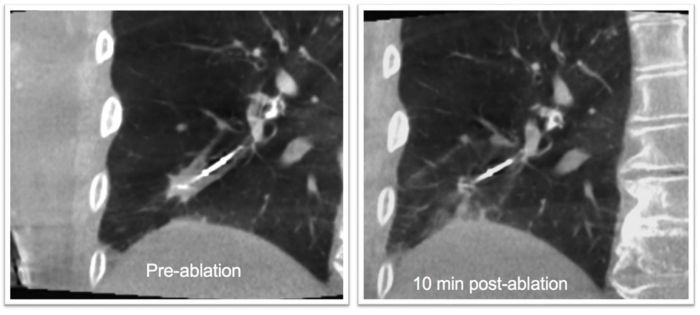 Philips Azurion lung ablation