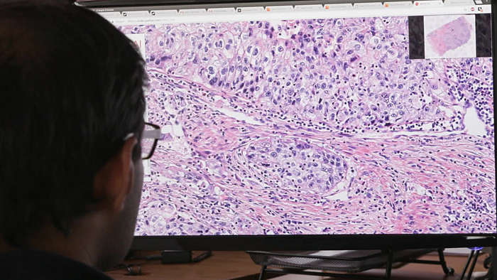digital pathology accurate diagnosis cancer computational, artificial intelligence, machine learning