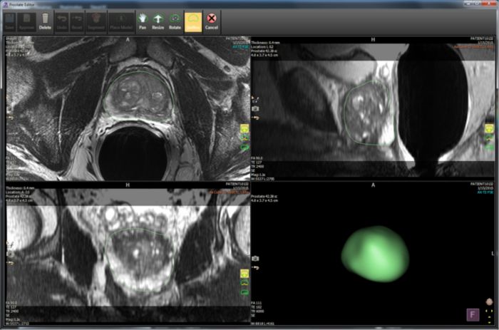 IntelliSpace Portal 10 supports Philips expansion into DynaCAD Prostate solutions