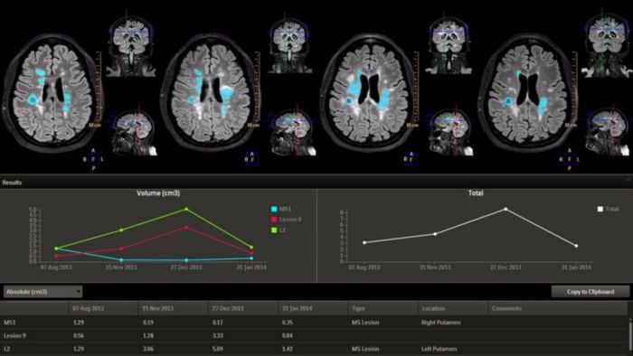 Philips, IntelliSpace Portal, Longitudinal Brain Imaging, Lobi, neurology