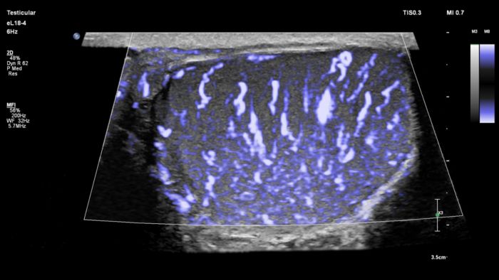 Philips MicroFlow Imaging