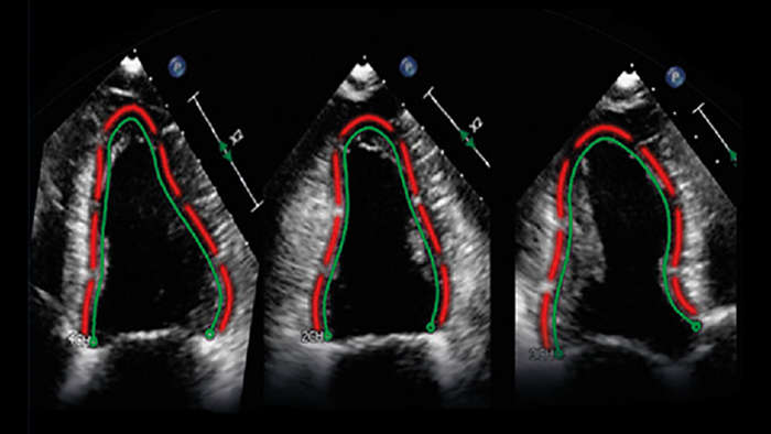 Philips, TOMTEC, acquisition, ultrasound, image analysis software, diagnostic ultrasound