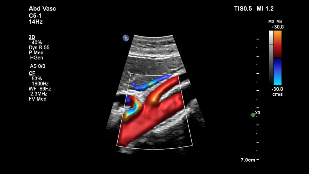Aorta with FlowViewer