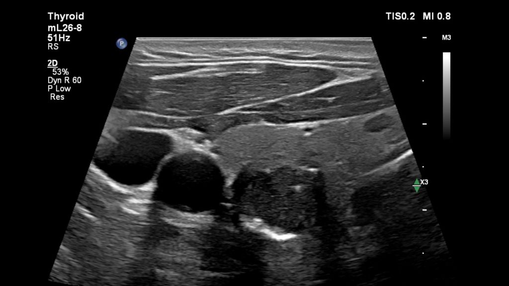 Thyroid