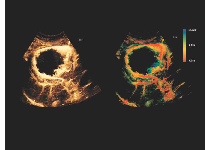 Contrast Enhanced Ultrasound (CEUS) | フィリップスヘルスケア