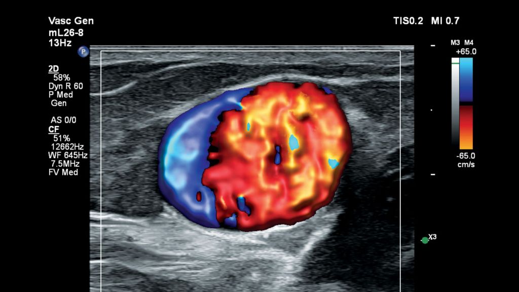 Fistula