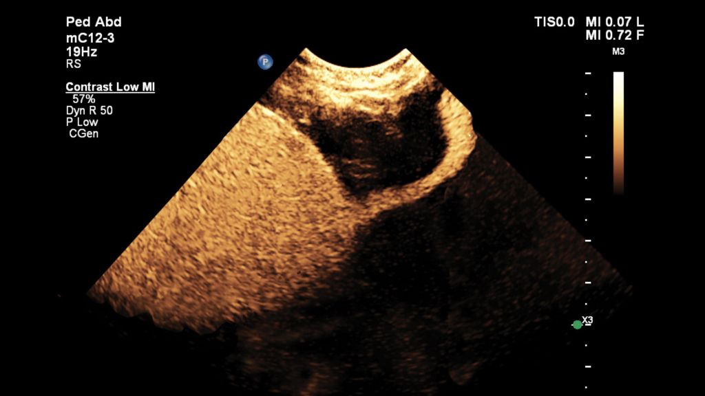Pediatric bladder CEUS