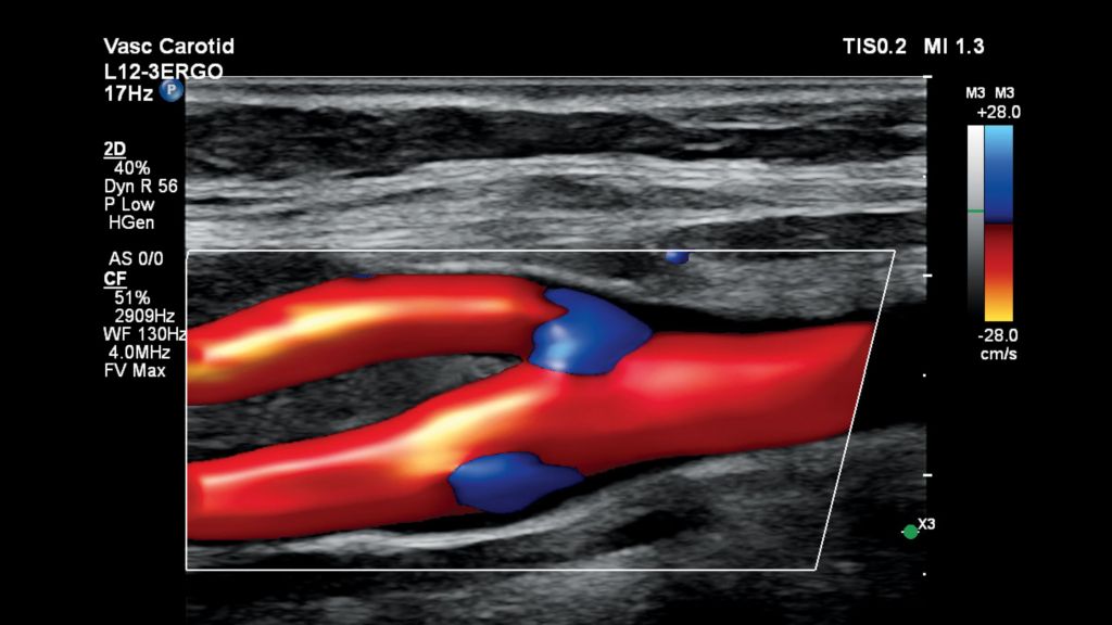 Carotid